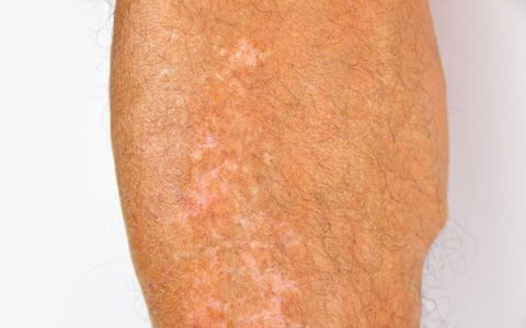 蛇缠腰疱疹怎么治疗好得快？实用方法分享不藏私【蛇缠腰疱疹怎么治疗好得快会传染吗】
