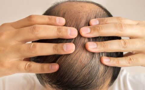 秃顶的人寿命短吗 秃顶还能否治吗